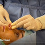 None sugical Rhinoplasty using threads